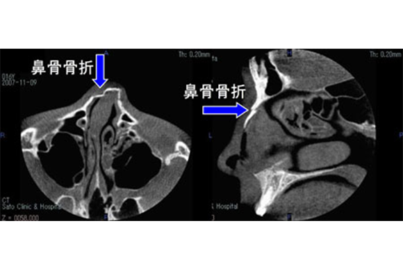 鼻骨骨折